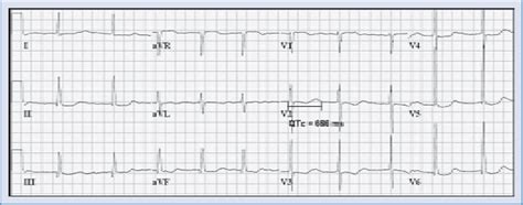 Multifactorial QT interval prolongation - PubMed