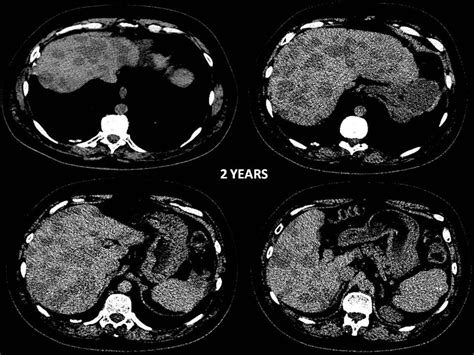 Multifocal nodular hepatic steatosis Eurorad