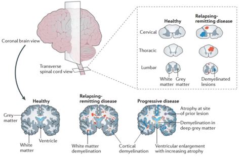 Multiple Sclerosis and helminthic therapy - Jasper Lawrence