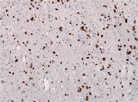 Multiple System Atrophy is First New Human Prion Disease Identified …