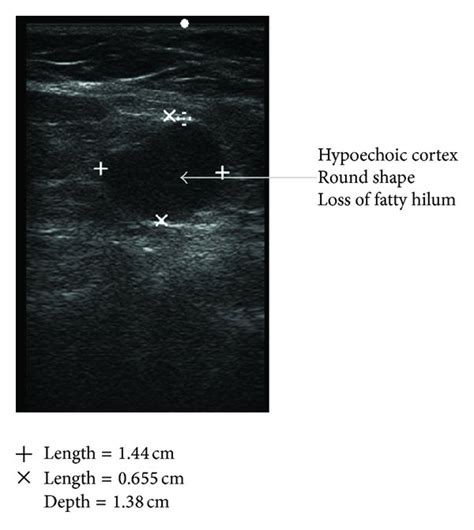 Multiple enlarged lymph nodes with fatty hilum Answers