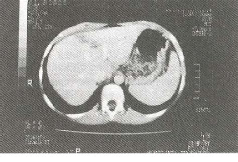 Multiple ill-defined hypodense nonenhancing nodules are seen in …