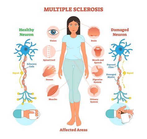 Multiple sclerosis MS Types symptoms and causes