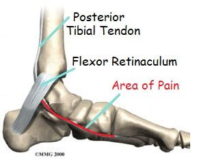 Muscle Knot in Arch of Foot: Cause, Diagnosis & Treatment