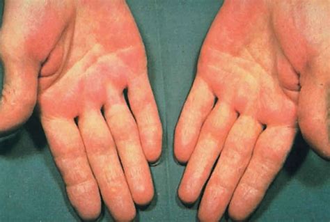 Muscle Weakness, Palmar Erythema & Thyrotoxicosis: Causes