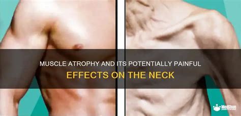 Muscle atrophy weakness and pain.  That can cause paralysis, which may c...