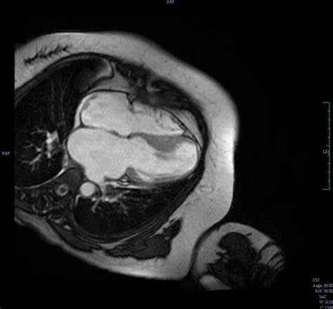 Mutation of the MYL3 gene in a patient with mid-ventricular …