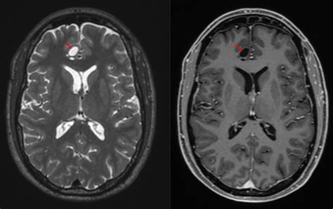 Jul 16, 2019 · We suspected that the lesions were MVNT, originally described as an epilepsy-related brain tumor. MVNT was first identified in 2013 in a case series of 10 patients as surgically resected brain tumors exhibiting varying degree of matrix vacuolization in the neuronal cells (Huse et al., 2013). Seven out of the ten patients had epilepsy and six of ... . 