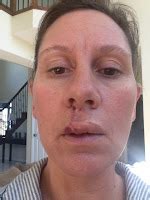 My Story: Mohs Surgery Upper Lip & Repair Surgery