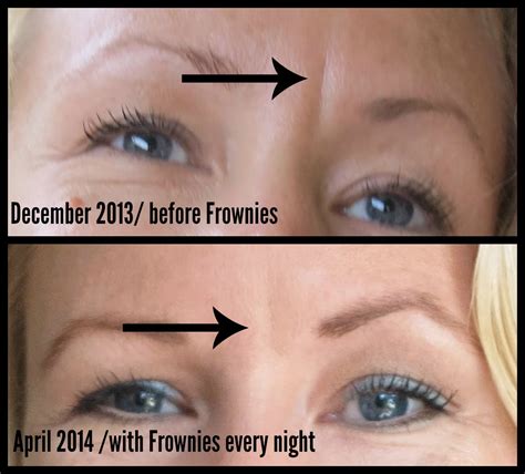 My experience with Frownies with before and after photo …