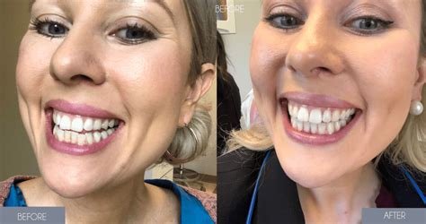 My invisalign. Crooked teeth are a common problem — and no one likes living with the side effects of an imperfect smile. From gaps to overlaps and slightly sideways to crowding, crooked teeth are... 