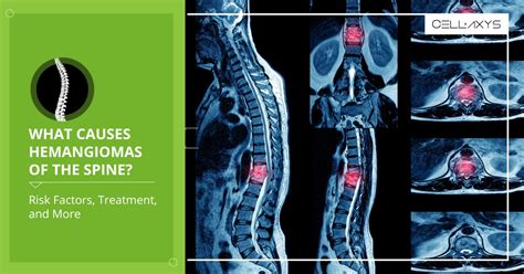 My spinal hemangiomas cause pain. .  <a href=https://bandcamp.gofulfil.com/...