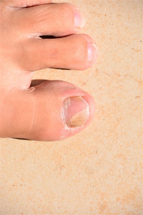 B35) Onychomycosis refers to any nail infection caused by dermatophytes, non-dermatophytes or yeasts. White superficial onychomycosis – direct invasion of the nail plate: causes the appearance of white or dull yellow sharply bordered spots on the surface of the nail. Atrophic: thinning and detachment of the nail plate.. 