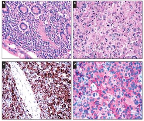 Myeloid Sarcoma American Journal of Clinical Pathology Oxford ...