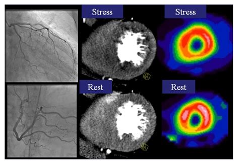 Myocardial perfusion imaging or stress MIBI scan Icardio