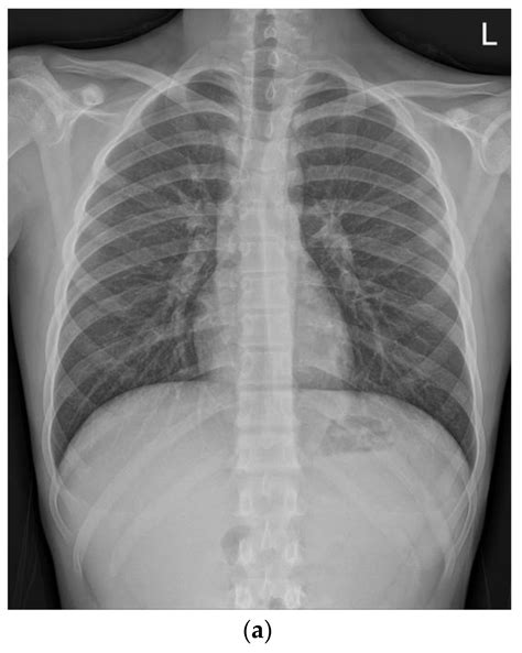 Myocarditis in Crohn