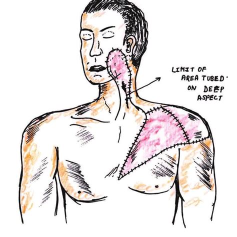 Myocutaneous flap definition of myocutaneous