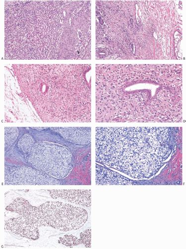 Myoepithelial Neoplasms Basicmedical Key