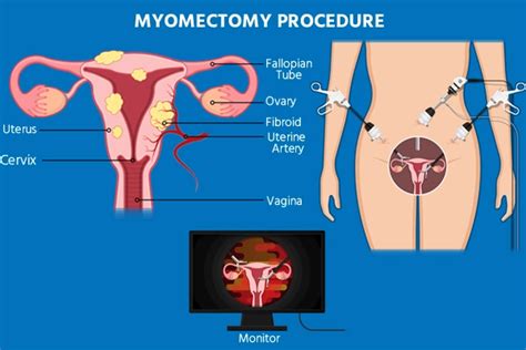 Myomectomy Procedure recovery and complications