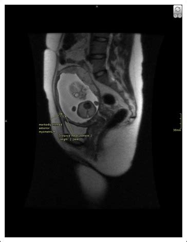 Myometrial Defect in a Subsequent Pregnancy After