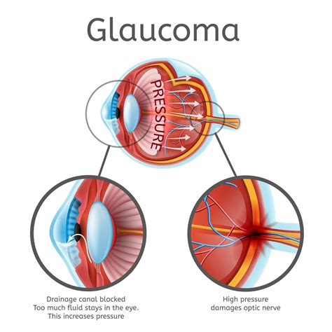 Myopia And Glaucoma