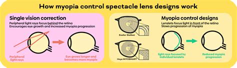 Myopia Control Clearvision