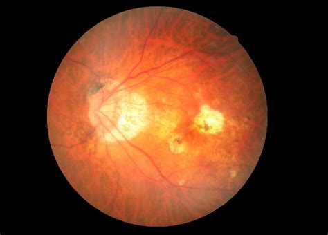 Myopic macular degeneration What it is and more