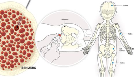 Näsblod barn leukemi
