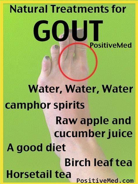 Natural treatments for gout | Complementary and Alternative ... - EBSCO - raincitystudios.com