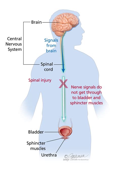 Neurogenic Bladder - Condition | UT Southwestern … - muktibox.com