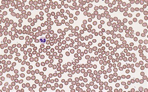 NOUL Blog nRBC Blood Test Why Accurate Detection is Critical and How