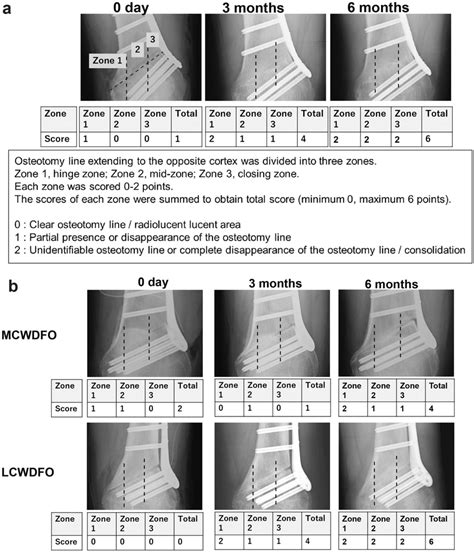 Novel Predictive Scoring System for Bone Union Rate After... : Spine - coolestguyplanet.net
