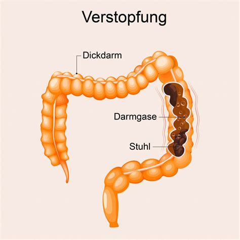 Nach durchfall verstopfung was tun