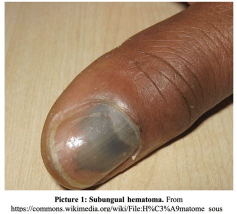 Nail Bed (Nailbed) Injury Management in the ED - Medscape