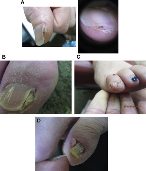 Nail Tumors - medicine world council