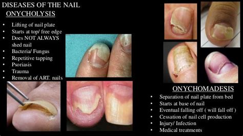 Nail Disorders1. Nail disorder -- caused by injury or disease 2. Brushed nails -- blood clot form under nail plate3. Ridges -- running vertical down the leng.... 