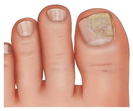 Nail fungus: Overview - InformedHealth.org - NCBI Bookshelf