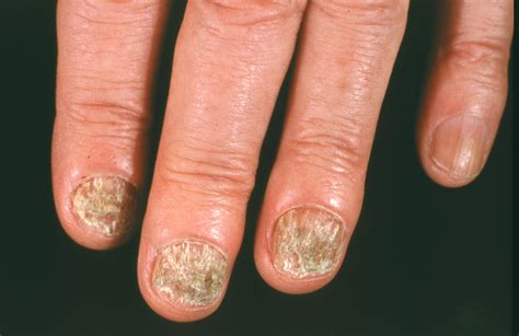 Nail fungus icd 10. Things To Know About Nail fungus icd 10. 