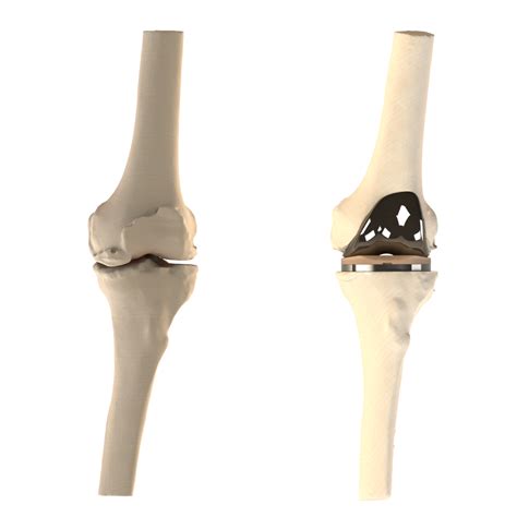 Nano knee. The 3D Printing Process for Knee Replacement. Receiving a customized prosthetic knee joint involves more steps than receiving a traditional knee implant, including: Obtaining high-resolution imaging of the knee joint. Creating a computer model of the natural joint. 3D printing of the custom joint by the manufacturer. 