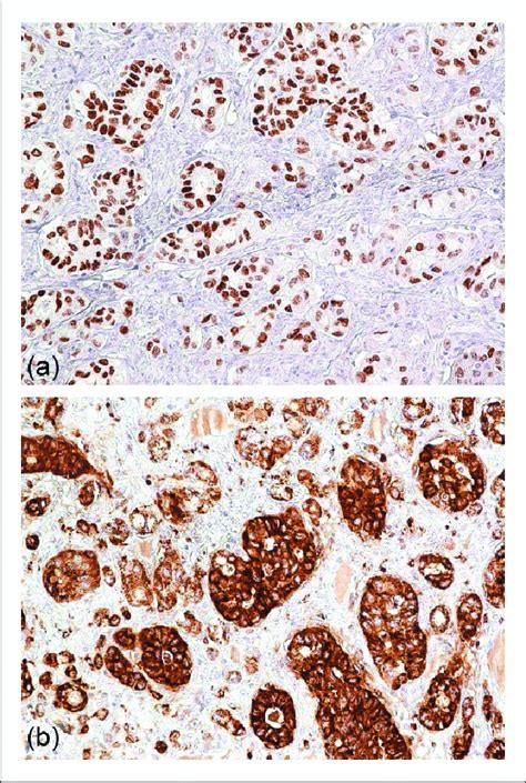 Napsin A and thyroid transcription factor-1 expression in