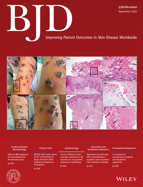 Narrowband ultraviolet B phototherapy is ... - Wiley Online Library