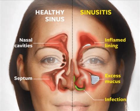 Nasal Congestion And Upset Stomach - MedicineNet