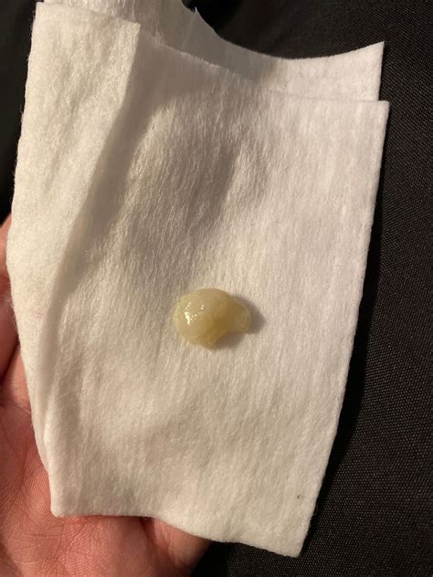 Mucus plug. Posted 6 years ago, 49 users are following. renee15737. For years I’ve suffered with a post nasal drip and build up of mucous at the back of my nose! When I get a cold it gets 10x worse. The mucus builds up to the point that it feels like it moves around and blocks my nasal passages so I can’t breath.. 