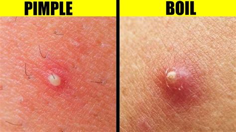 Tender, deep nodule (s) appears. The first sign of HS is often a painful spot that looks like a deep pimple, acne cyst, or boil. This spot often appears on an armpit (as shown here) or in the groin area. Some people develop a …. 