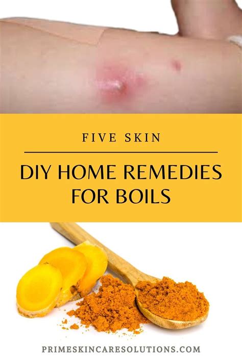 Natural Remedies for Boils