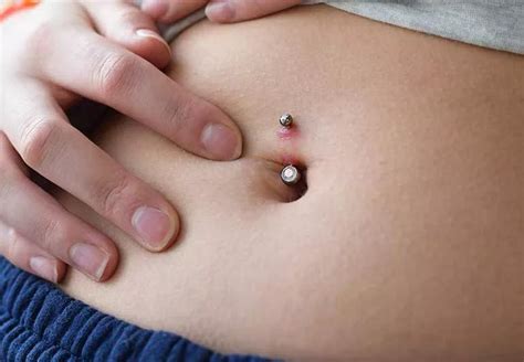 Navelpiercing infektion