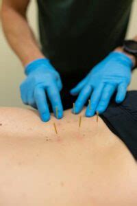Navigating Dry Needling Unveiling Potential Complications