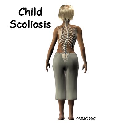 Navigating Scoliosis: A Comprehensive Guide to Resources and Support