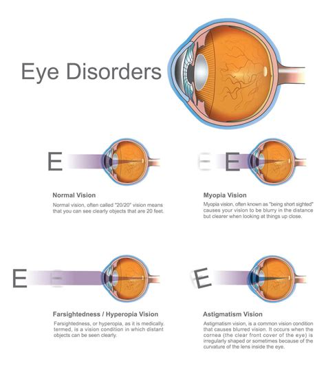 Nearsightedness Eye Disorders Ophthalmology Area of Care