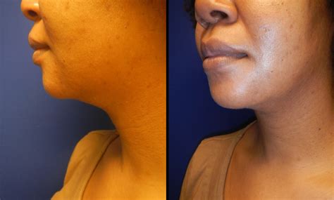 Neck And Chin Contouring Memphis Plastic Surgery